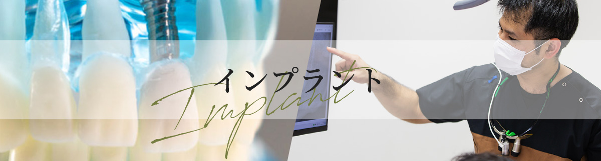 インプラント